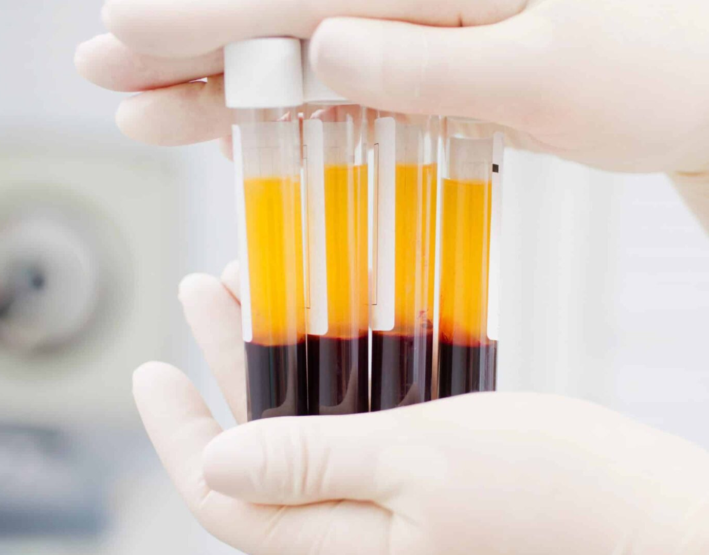 Platelet Rich Plasma (PRP)