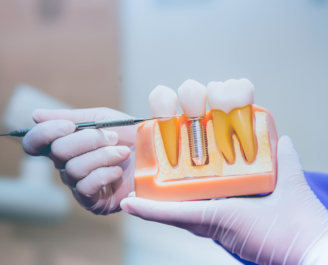 CT Guided Implant Surgery
