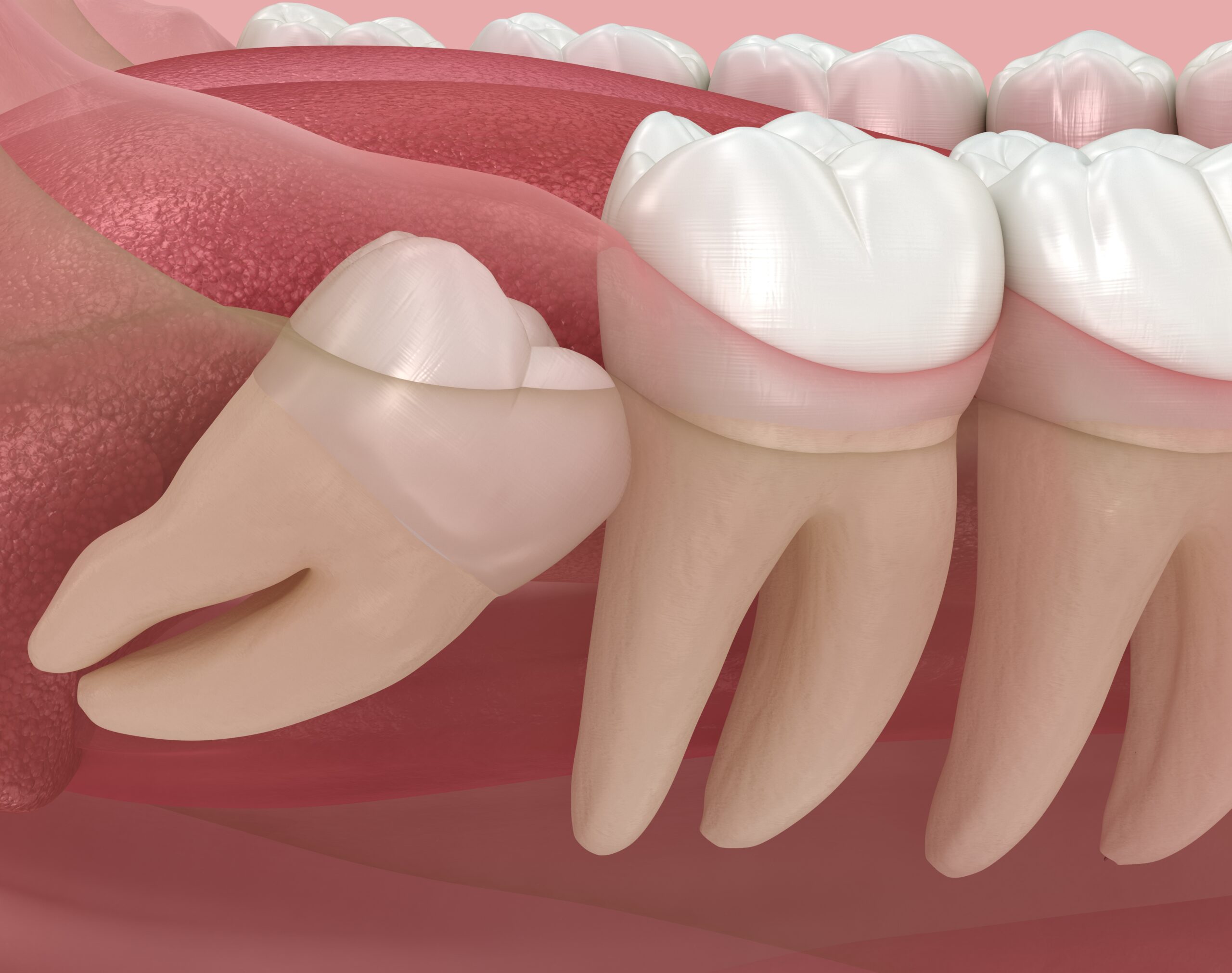 Impacted Teeth